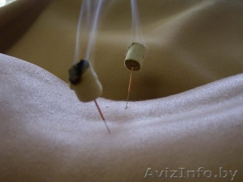 Иглы для рефлексотерапии - Изображение #3, Объявление #592168