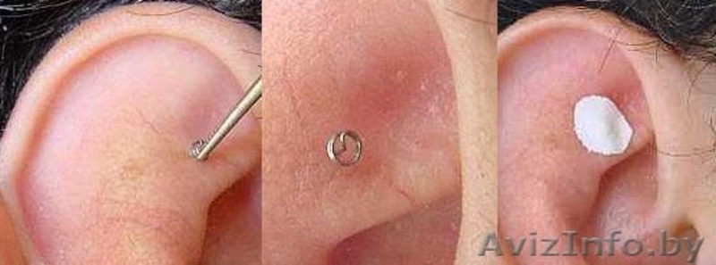 Иглы для рефлексотерапии - Изображение #6, Объявление #592168