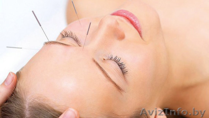 Иглы для рефлексотерапии - Изображение #4, Объявление #592168