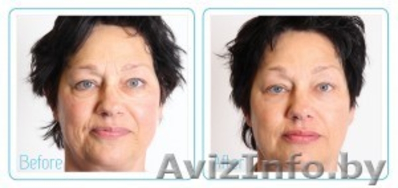 МЕТАТЕРАПИЯ–альтернатива хирургической подтяжке  тканей лица - Изображение #3, Объявление #919492