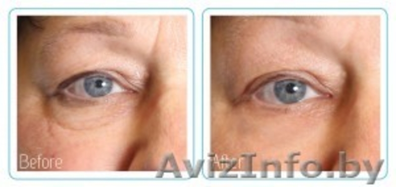 МЕТАТЕРАПИЯ–альтернатива хирургической подтяжке  тканей лица - Изображение #4, Объявление #919492