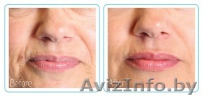 МЕТАТЕРАПИЯ–альтернатива хирургической подтяжке  тканей лица - Изображение #5, Объявление #919492