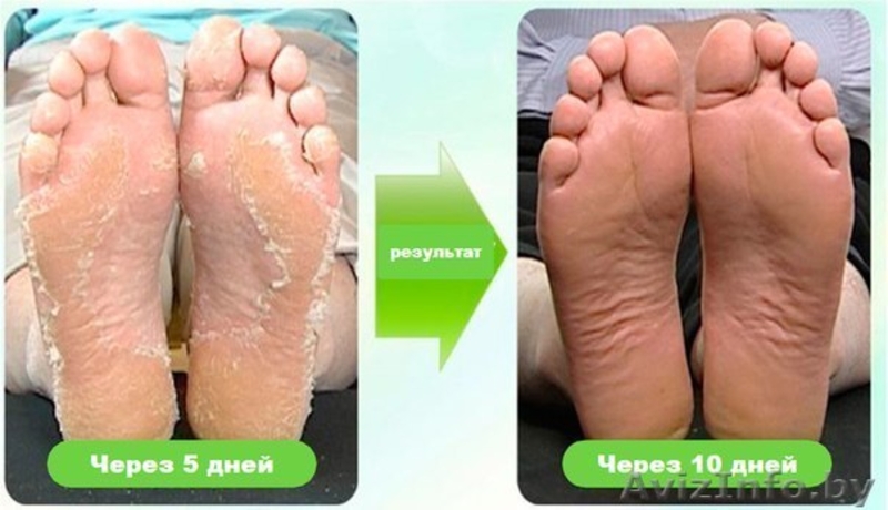 Педикюрные носочки BRAPHY. - Изображение #3, Объявление #1167189